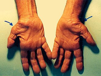 腕隧道症候群(carpal tunnel syndrome)